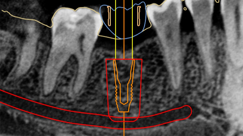 Imaging data is used to create surgical guides for the implantologist who inserts the dental implant.