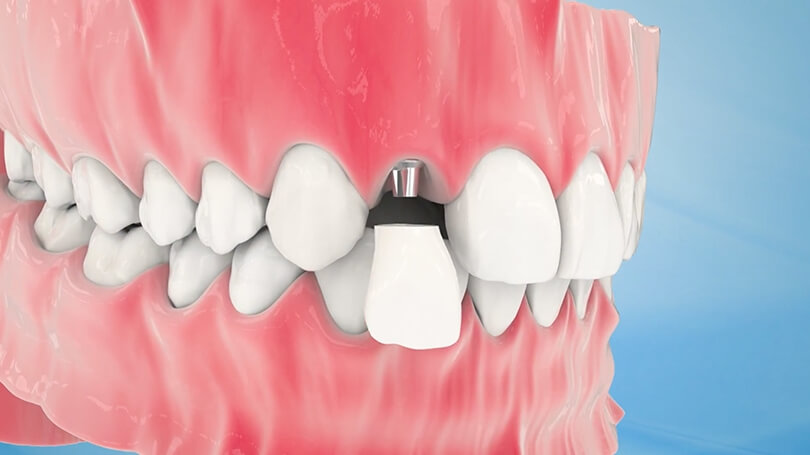 Dental implants are commonly used to replace a single tooth or a more complex restoration.