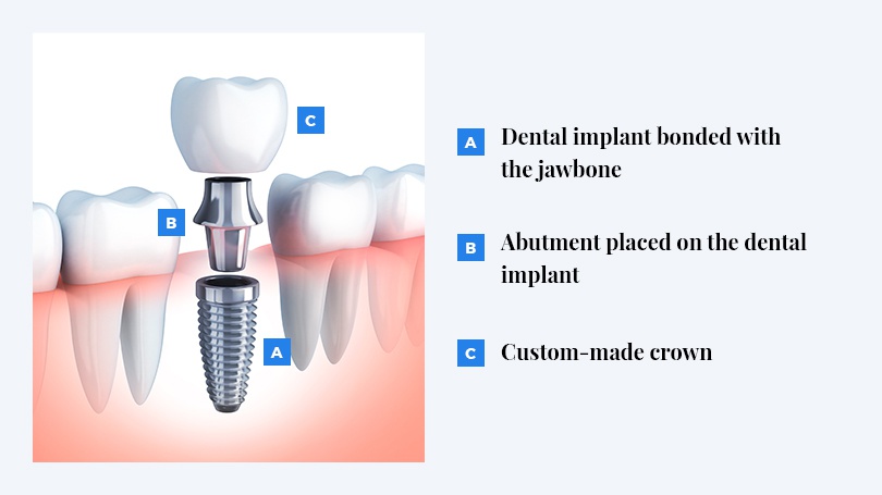 The dental implants available in Scottsdale can last a lifetime and help avoid future bone loss.