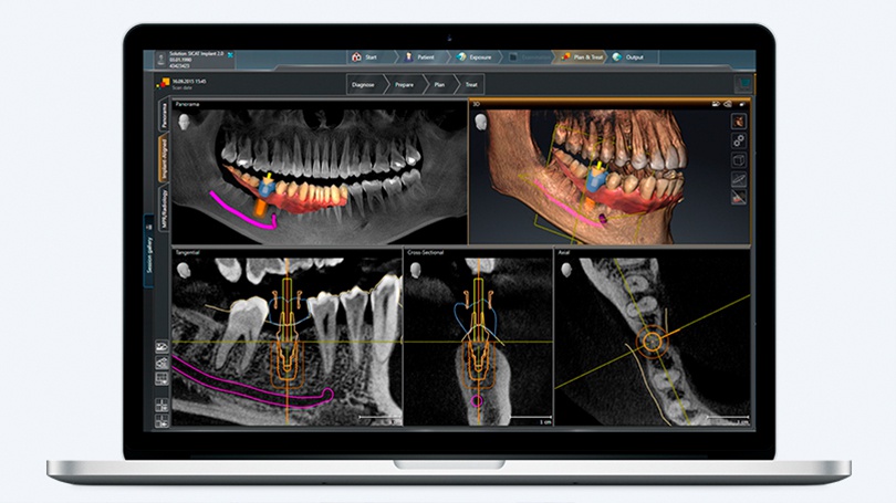 Advanced software allows your dentist to plan the implant procedure with a great degree of accuracy.