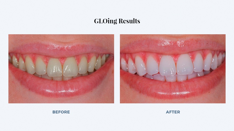 After a thorough cleaning, the whitening process involves a bleaching agent, a mouthpiece and lights.