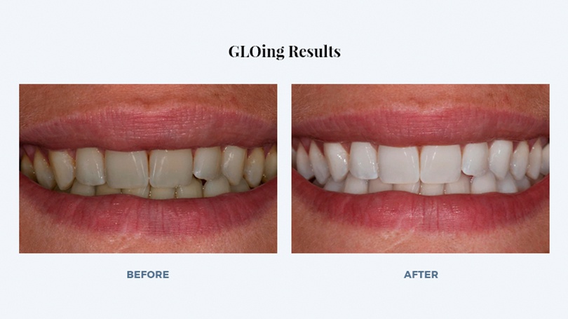 Many people in Scottsdale enjoy beautiful white smiles thanks to GLO teeth whitening.