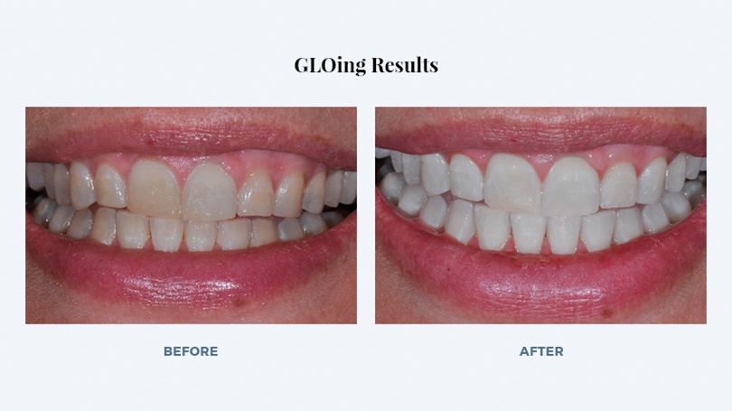 Brighten your teeth and keep them white with GLO in-office teeth whitening.