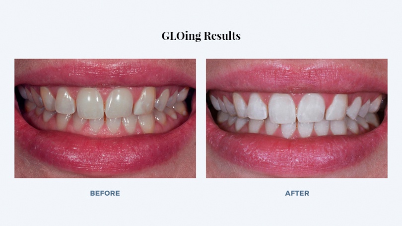 Dental bleaching can last six months or even longer.