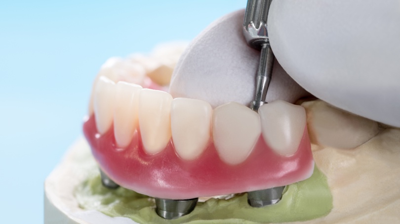 If you are missing some or all of your teeth, consider implant-supported dentures.