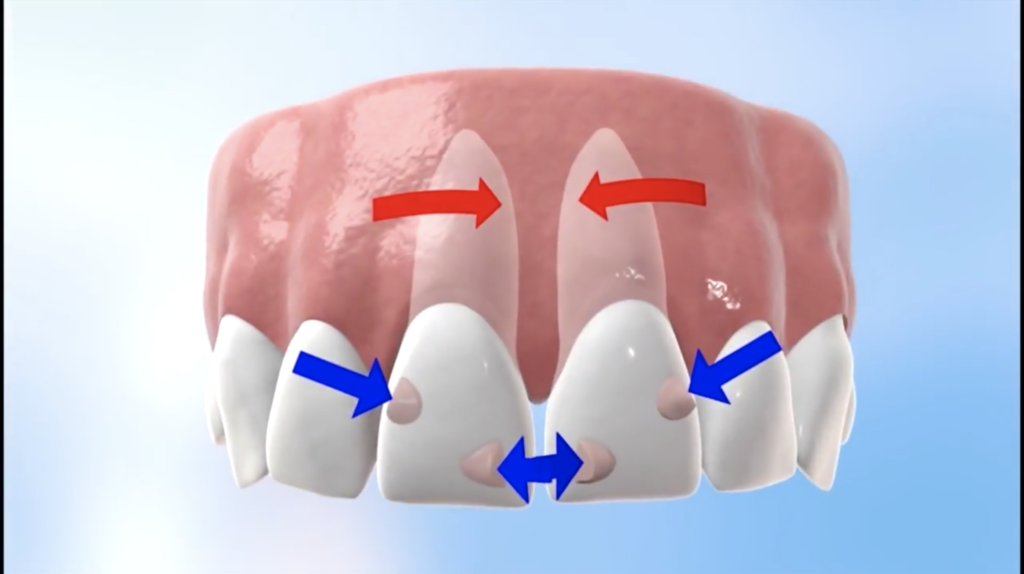 Invisalign clear aligners in Scottsdale will correct your teeth without the hassles of conventional metal braces.