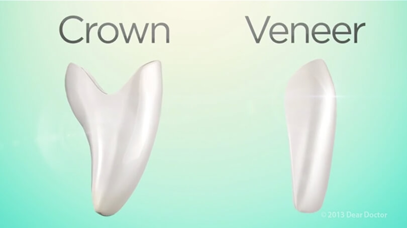 Porcelain veneers are commonly used to get a perfectly white, aligned and gorgeous smile.
