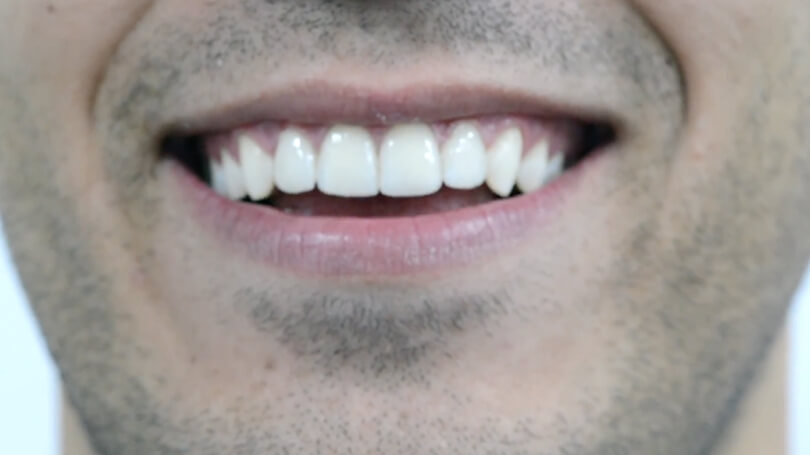 eMax porcelain veneers are custom-made to your teeth and are as durable as enamel.