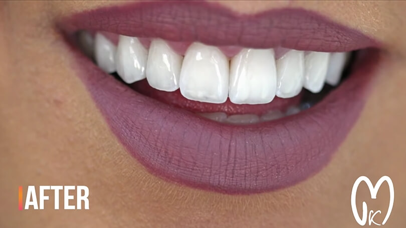 You can correct many cosmetic issues with porcelain veneers, including chips, cracks, gaps, discoloration, and more.