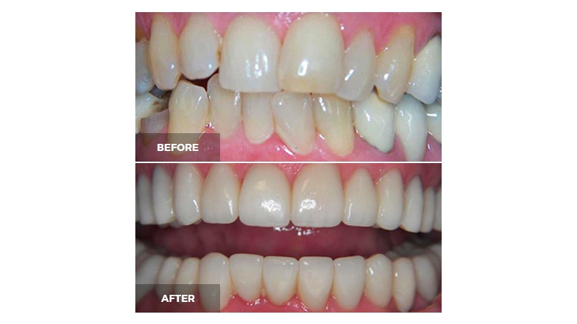 Restorative treatments can be part of your smile makeover in Scottsdale as well.