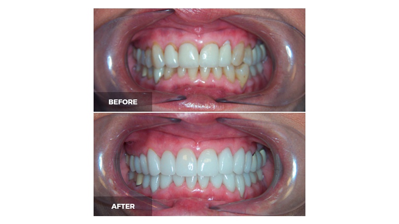 Your smile makeover options in Scottsdale may include teeth whitening, porcelain veneers and Invisalign clear aligners.