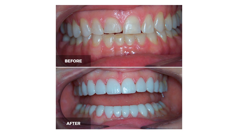 The goal for each smile makeover is always the same: a beautiful and long-lasting smile.