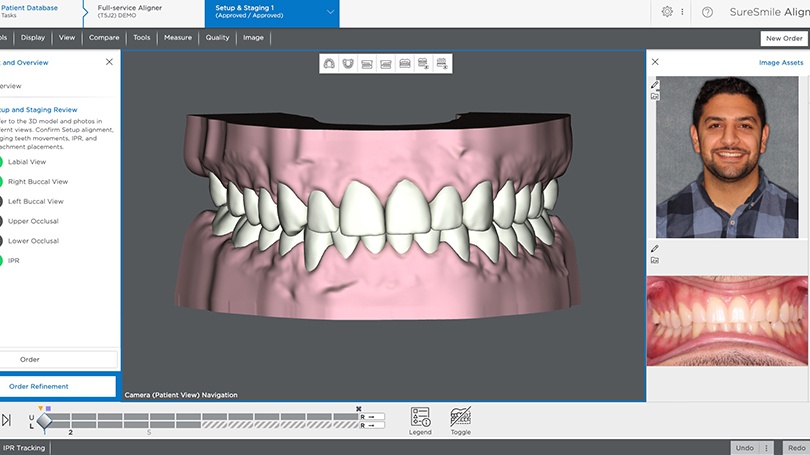 Specialized software will then be used to extrapolate the movement of your teeth over time.