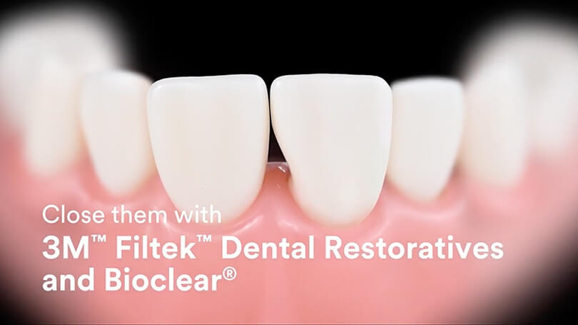 Bioclear dental restorations are minimally invasive and produce results that look natural and last for years.