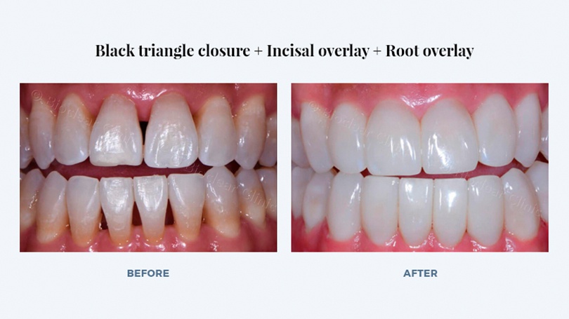 This treatment involved a Bioclear restoration along with an incisal overlay and in-office teeth whitening.