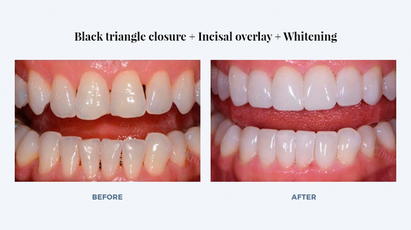 An example of how a Bioclear 360 veneer can correct serious damage to a tooth.
