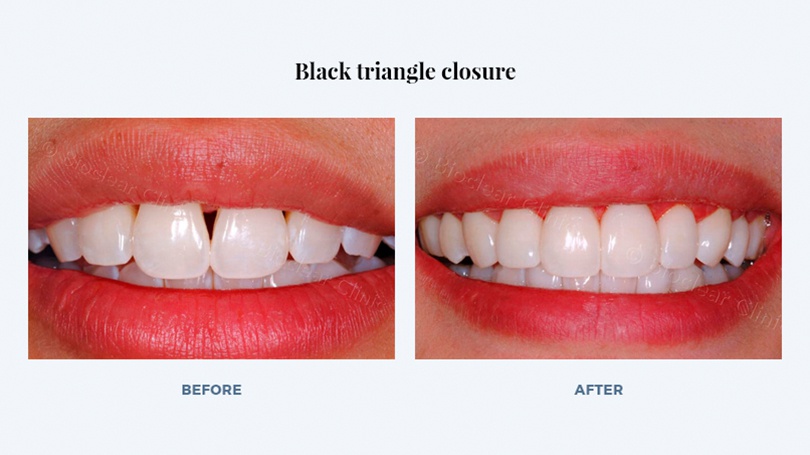 Many patients in Scottsdale with black triangles are amazed at the difference Bioclear restorations make.