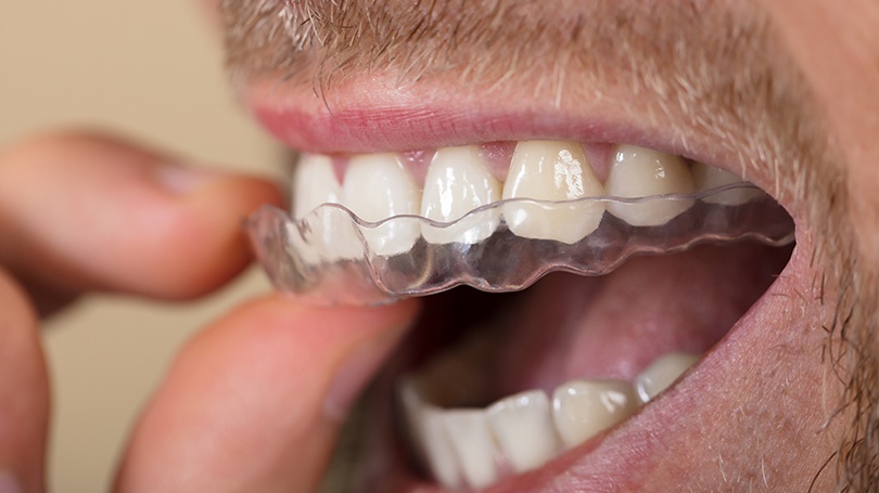 Often, custom-fit night guards are the only bruxism treatment our Scottsdale patients need.