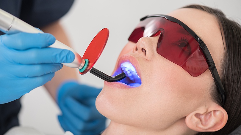 After a thorough cleaning of your teeth, the thin protective coating will be applied and smoothed.