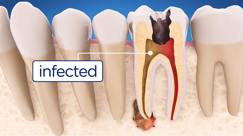 With endodontic treatments, typically called root canal therapy, we can help save a severely damaged tooth.