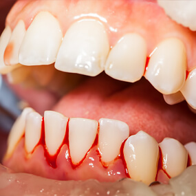 How to avoid bleeding gums and what to do if it happens.