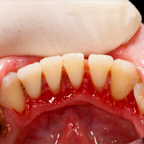 Science has found a correlation between gum disease and cancer.
