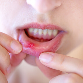 Natural home remedies to treat canker and cold sores.