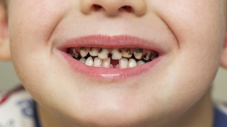 What Causes Children S Cavities And How To Avoid Them Scottsdale   What Causes Childrens Cavities And How To Avoid Them 768x431 