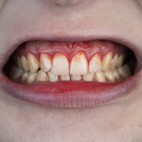 Gum disease can develop into a serious infection that causes tooth loss.