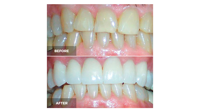 Veneers are a great way to cover teeth where the yellow dentin shows through the enamel.
