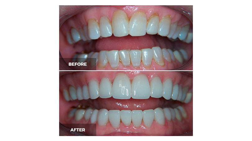 Dental calculus that has accumulated over time can be removed for a beautiful smile.