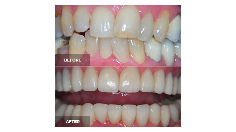 Even teeth yellowed with time or due to smoking can be corrected.