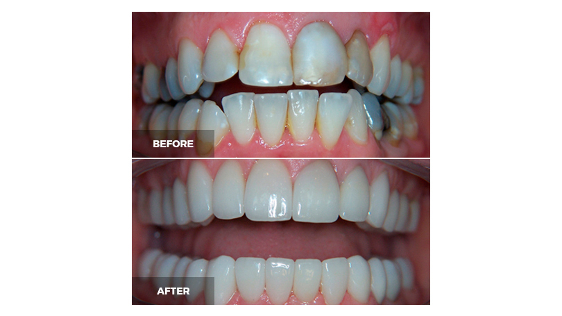 You may be amazed at just how much a smile makeover can improve your appearance.