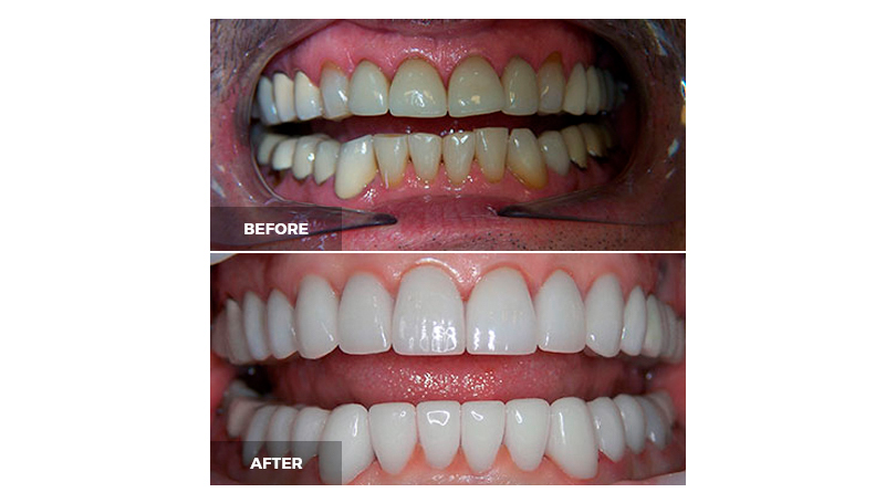 Even teeth that have an irregular size or shape can be beautified.